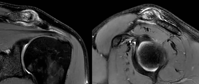 Artrose Acromioclavicular: O Que é, Causas, Sintomas e Tratamentos para Alívio da Dor no Ombro